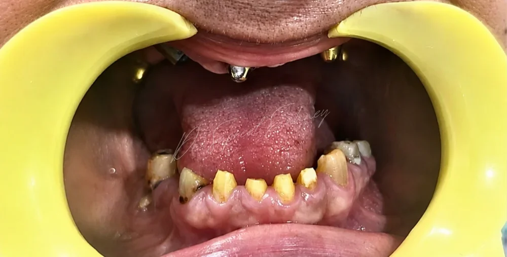 Frontal retracted intraoral photograph showing remaining teeth and visible implant abutments before rehabilitation